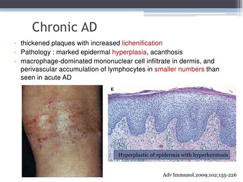 Atopic Dermatitis Mechanism Of Disease
