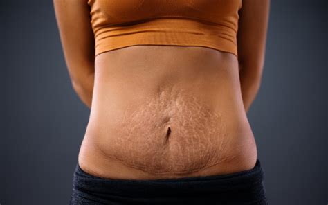 4 Ways To Get Rid Of Belly Bulge After Pregnancy MFine