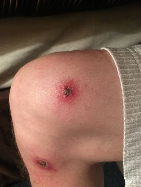 Pin On Brown Recluse Spider Bite