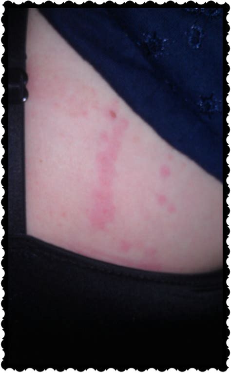 What Do Bed Bug Bites Look Like Hubpages