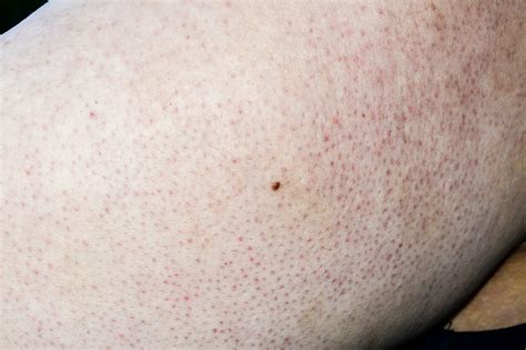 Keratosis Pilaris Here S What You Need To Know May