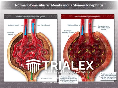 Normal Glomerulus Vs Membranous Glomerulonephritis Trial Exhib