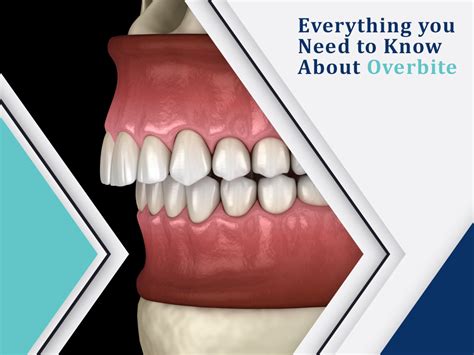 Everything You Need To Know About Dental Overbite Condition