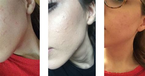 How I Tackled My Hormonal Acne