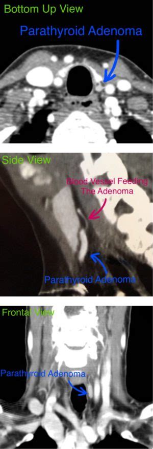 Scans For Abnormal Parathyroid Glands Dr Babak Larian