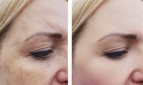 Reverse Sun Damage With Fraxel Laser Treatments Ultimate Image