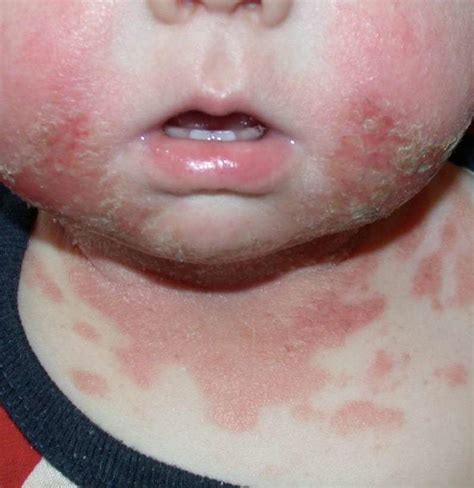 Real Life Experience How To Treat A Rash Toddler