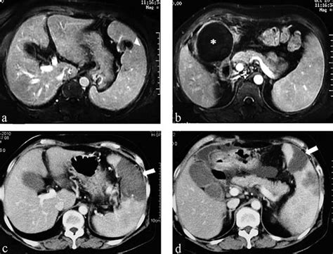 Preoperative Contrast Enhanced Mri Images Revealed A Solitary Splenic