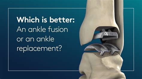 Which Is Better An Ankle Fusion Or An Ankle Replacement Youtube