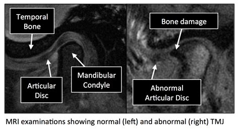 Radiology Anatomy Images Temporomandibular Joint Mri Anatomy
