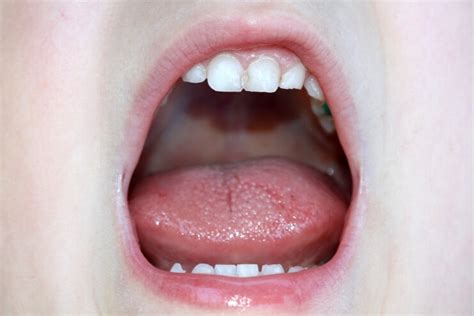 Your Tongue A Fascinating Phenomenon With Dental Benefits Too