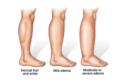 Does Lymphedema Need To Be Treated By Sante And Physique Medium
