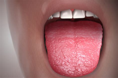 Dry Mouth And Tongue General Center