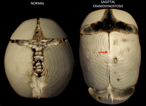 Pediatric Sagittal Synostosis