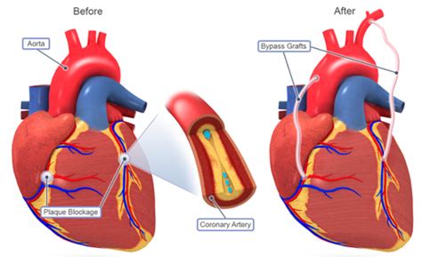 10 Best Clinics For Coronary Artery Bypass Graft Cabg Surgery In Al