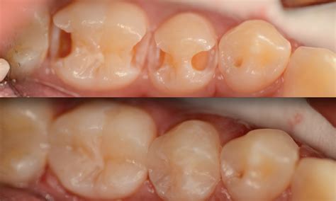 Dental Fillings Patient Before And After Alpharetta Dentist