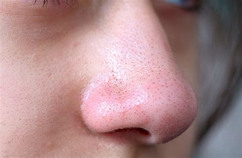 Pimples Acne Zit Blackheads On The Nose Of Teenager Stock Photo Stock