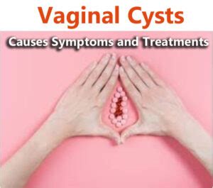 Vaginal Cysts Causes Symptoms And Treatments Healthfitns Com
