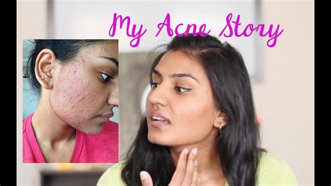 My Acne Story Skin Care Routine Youtube