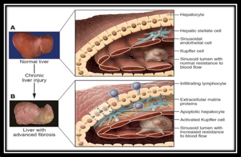 Complications Of Cirrhosis Hammound Pbl Flashcards Quizlet