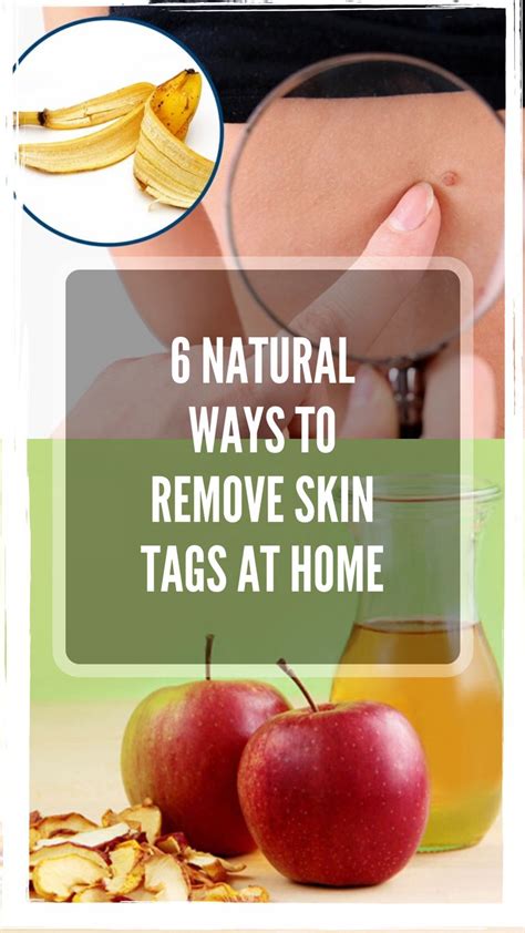 6 Natural Ways To Remove Skin Tags At Home Skin Tag Skin Tag Removal