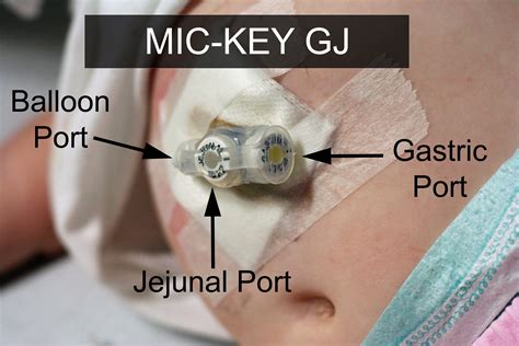 A Gastro Jejunal Or Gj Tube Can Be A Great Aid For Individuals With