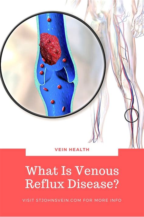 Venous Reflux Disease Is A Progressive Medical Condition And If Left