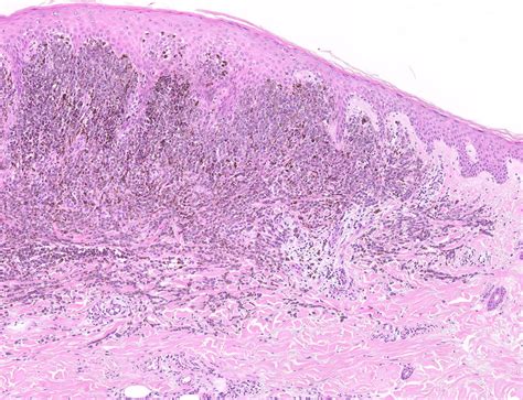 Histology Showing Superficial Spreading Component Of