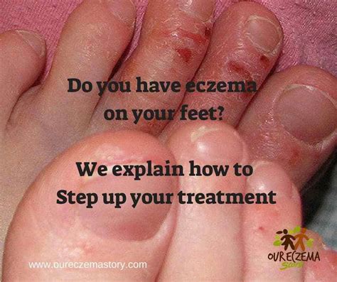 Eczema On My Feet Step Up Your Treatment Eczema Skin Care Natural