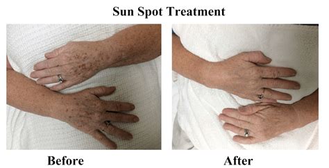 Age Spot Sun Spot Removal Raleigh Skin Essence A Day Spa