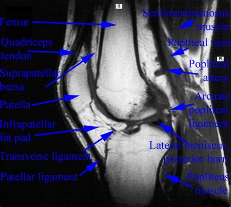 The muscles of the knee include the quadriceps, hamstrings, and the muscles of the calf. Department of Anatomy, Med. Univ. of Warsaw, Poland - Knee MRI - Scan 40