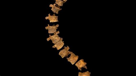 A Case Of Scoliosis Richard Iiis Spine Was Twisted Not Hunched Cnn