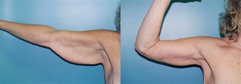 Arm Lift Before And After Photo Deluca Plastic Surgery