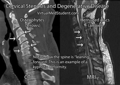 VirtualMedStudent Cervical Myelopathy And Stenosis