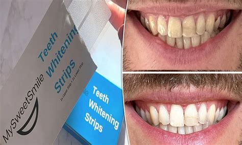 Shoppers Say These £30 Teeth Whitening Strips Make Their Smile Sparkle