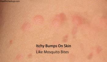 Itchy Bumps On Skin Like Mosquito Bites Causes Treatment Prevention