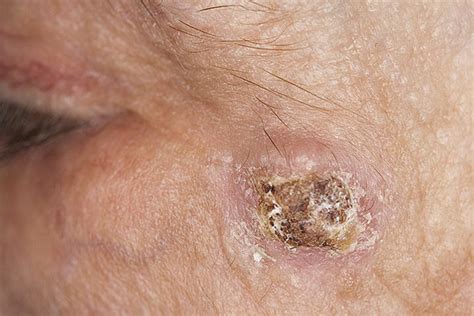 Skin Cancer Spots On Face All In One Photos