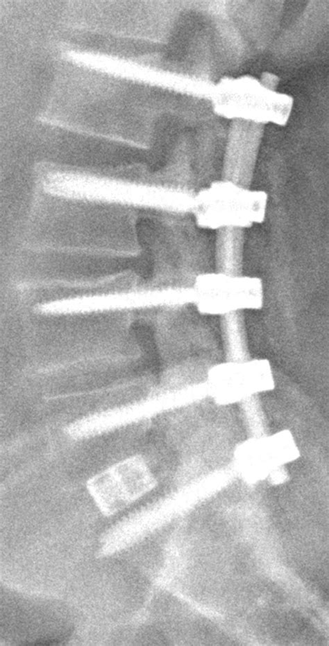 Lumbar Spine Radiology U Of U School Of Medicine