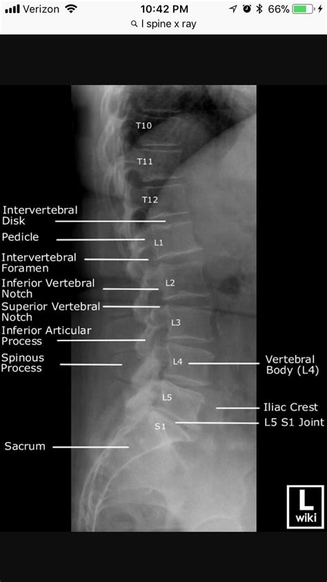 The lsa is formed by two lines: Lateral Lumbar Spine xray | Radiology, Radiology student ...