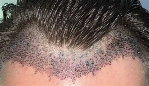 What You Need To Know About Shedding After A Hair Transplant