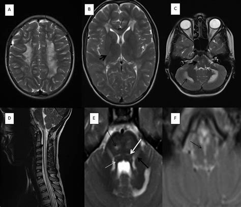Mri Findings In Our Patient A Axial T2 Weighted Image Reveals