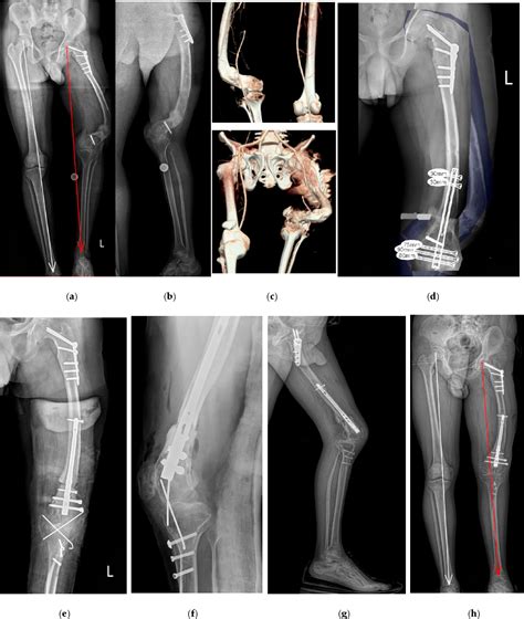 Figure 4 From Corrective Osteotomies In Severe Non Idiopathic Lower