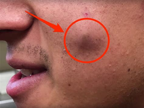 Dr Pimple Popper Video Shows A Cheek Cyst Full Of Oatmeal