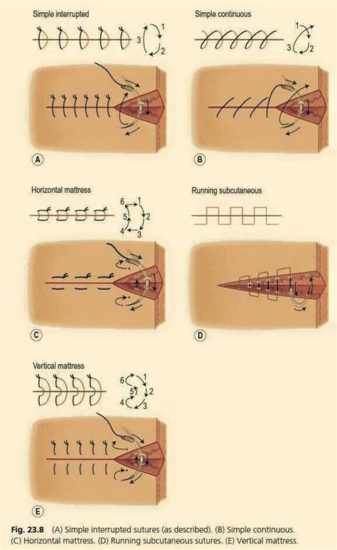 Suture Types Pa School Pinterest Medical Survival And Medicine
