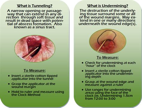 Tunnelingunderminingpng 803×614 Home Health Nurse Wound Care