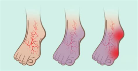 If You Have Poor Circulation Cold Feet Or Varicose Veins Start Doing
