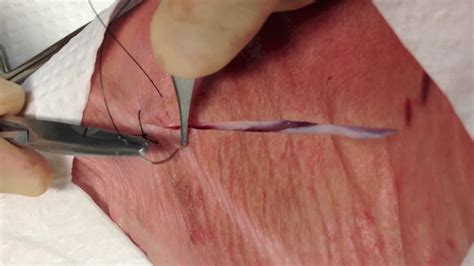 Because these lesions may spontaneously resolve. Running Percutaneous Sutures | Closing the Gap