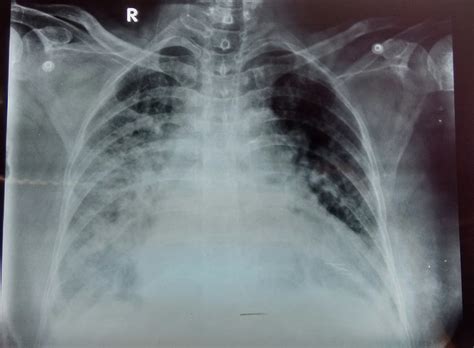 Pulmonary Edema Chest X Ray ~ Staff Nurses In India
