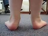Pictures of Foot Flat