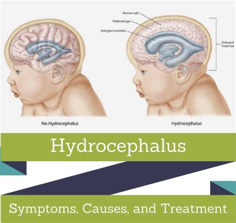 Hydrocephalus Symptoms Picture Causes And Treatment